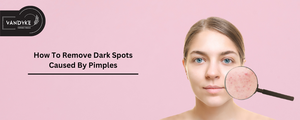 How To Remove Dark Spots Caused By Pimples