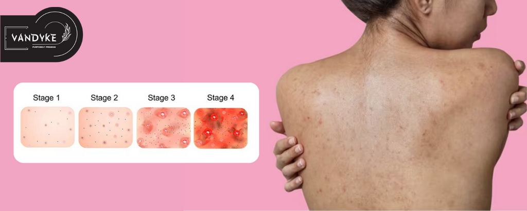 What Are The Causes of Body Acne?