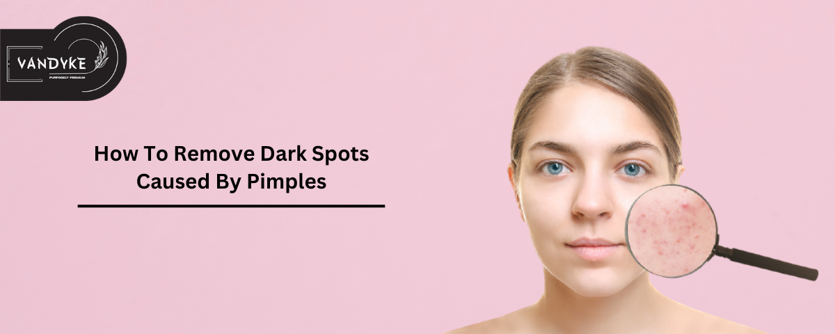 How To Remove Dark Spots Caused By Pimples - Vandyke