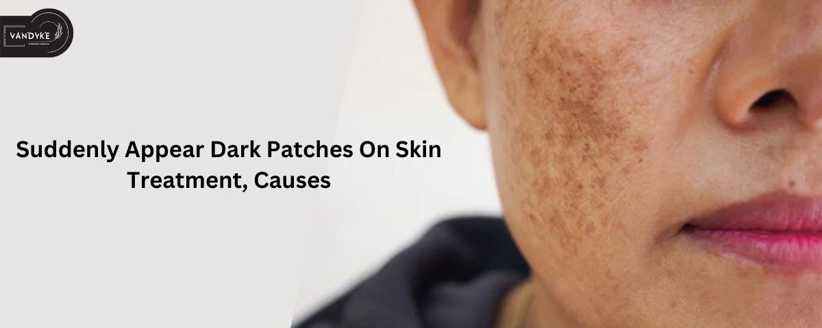 Suddenly Appear Dark Patches On Skin Treatment, Causes - VANDYKE